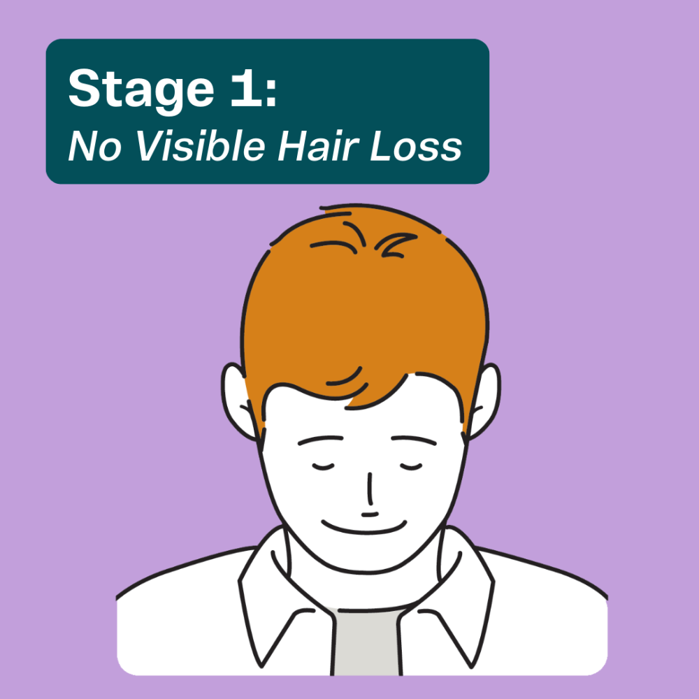Stage 1 Mens Hair Loss