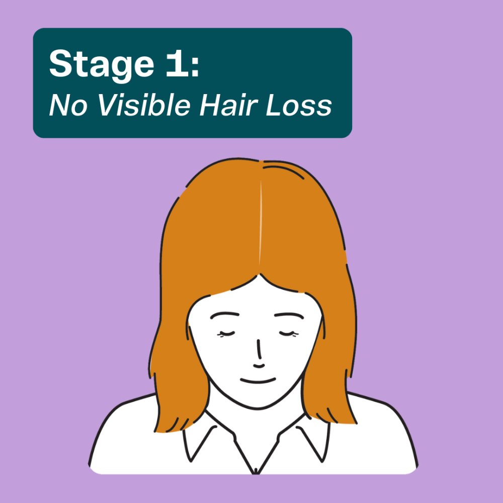 Stage 1 hair thinning in women