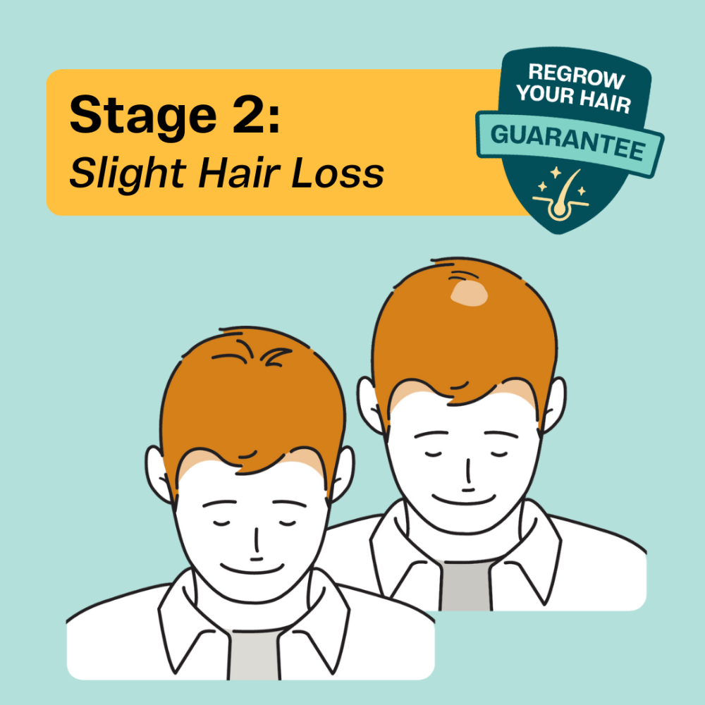 Stage 2 mens hair thinning
