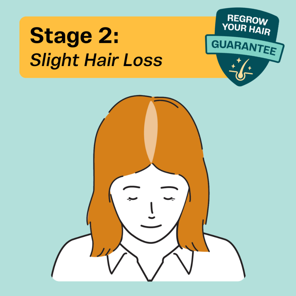 Stage 2 hair thinning in women