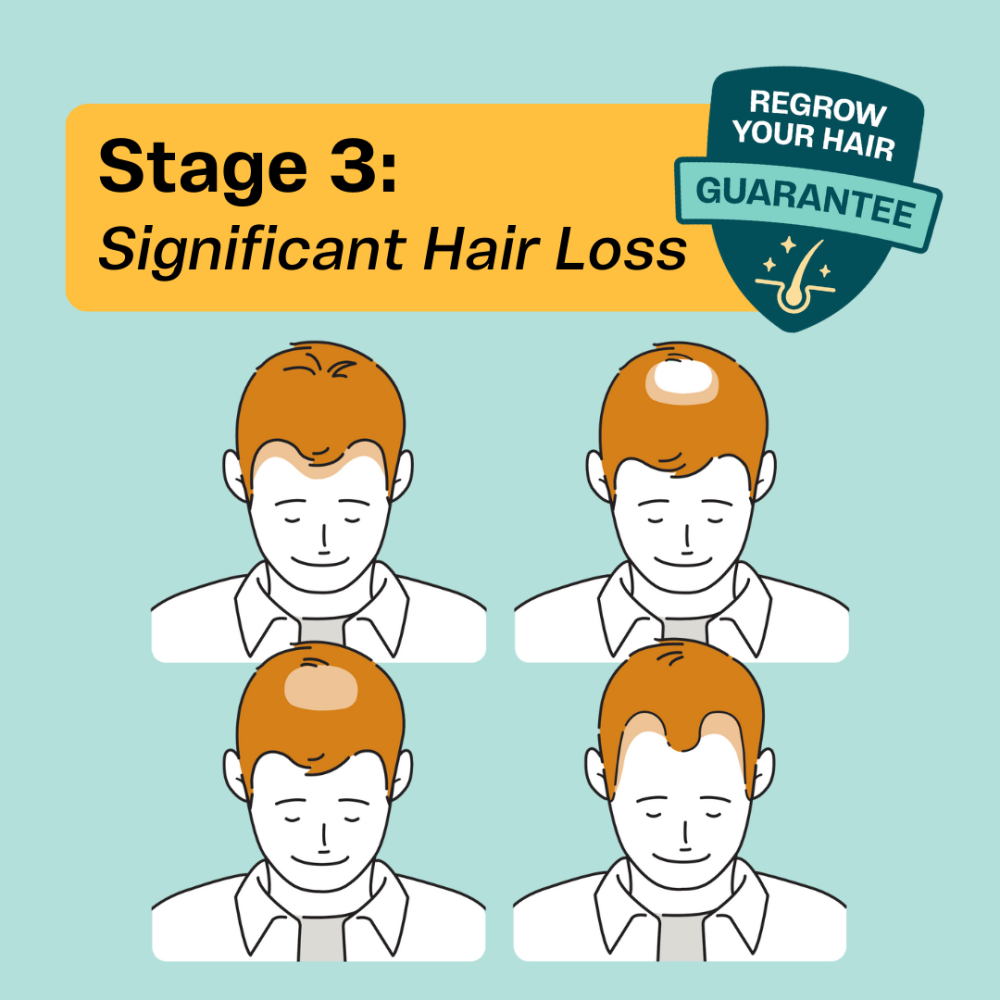 Stage 3 mens hair loss