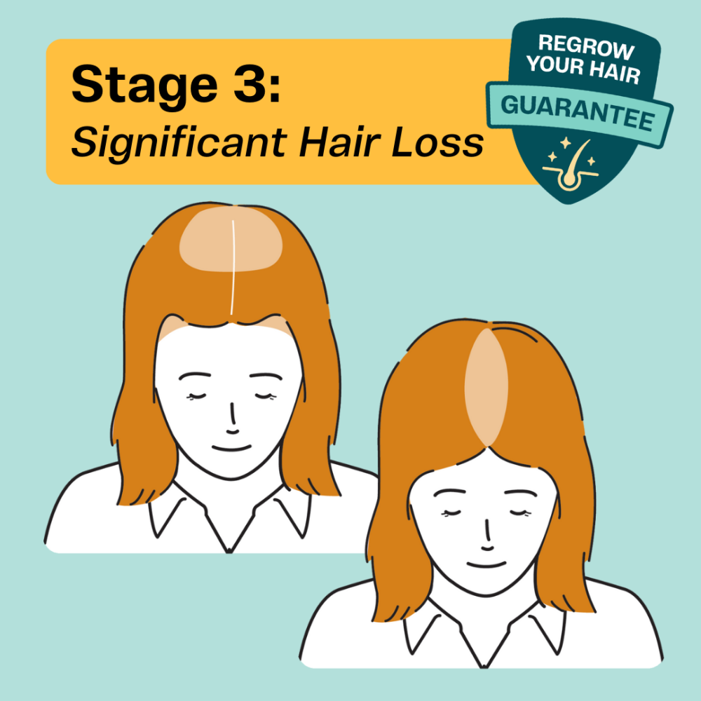 Stage 3 Womens Hair Loss