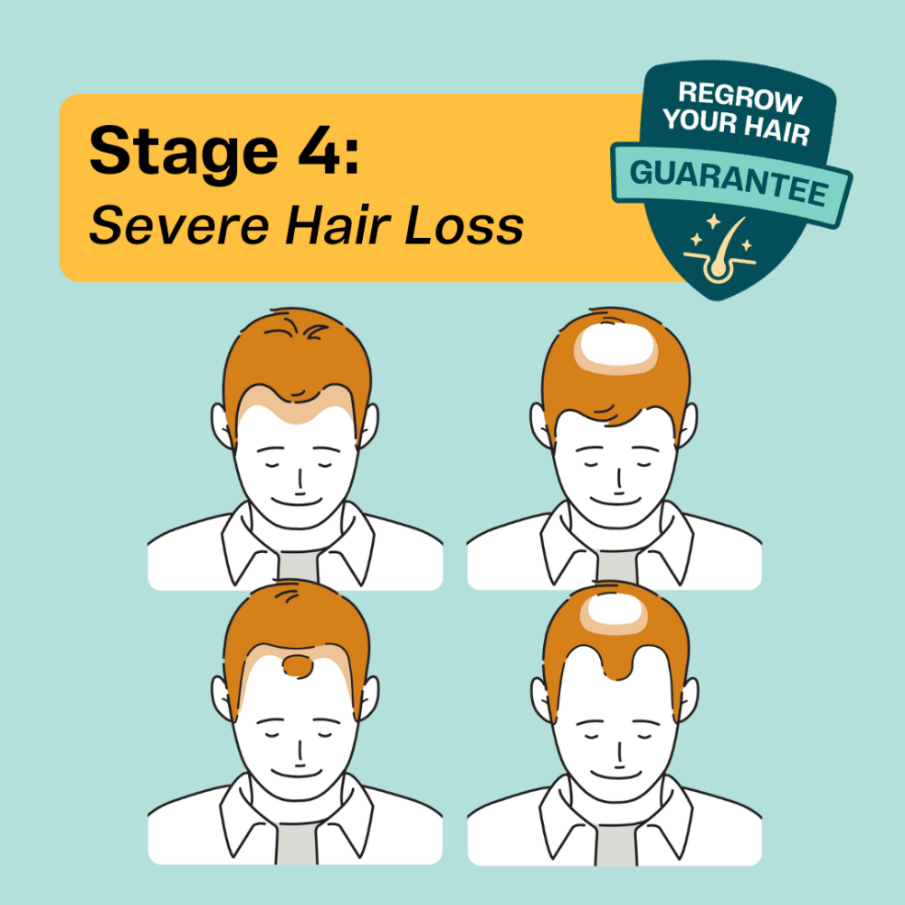 Stage 4 balding in men