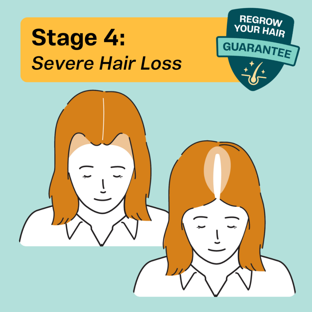 Balding in women at Stage 4