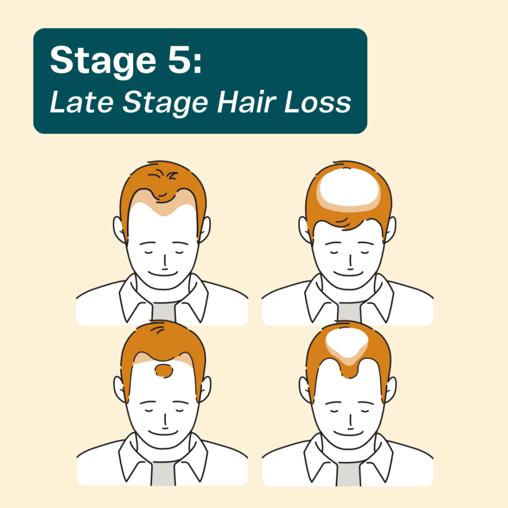 Stage 5 hair loss in men