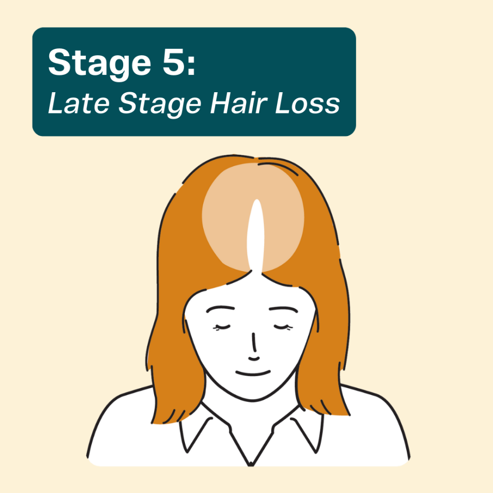 Female hair loss at Stage 5