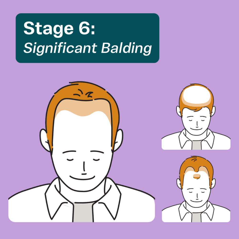 Stage 6 balding in men