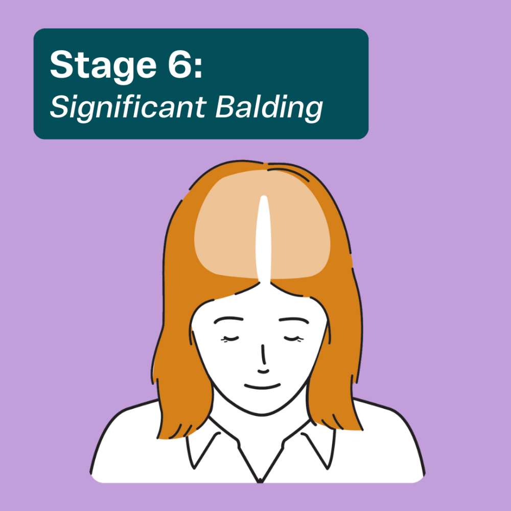 Stage 6 balding in women
